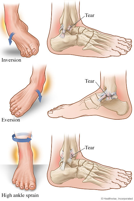 ankle injury 2